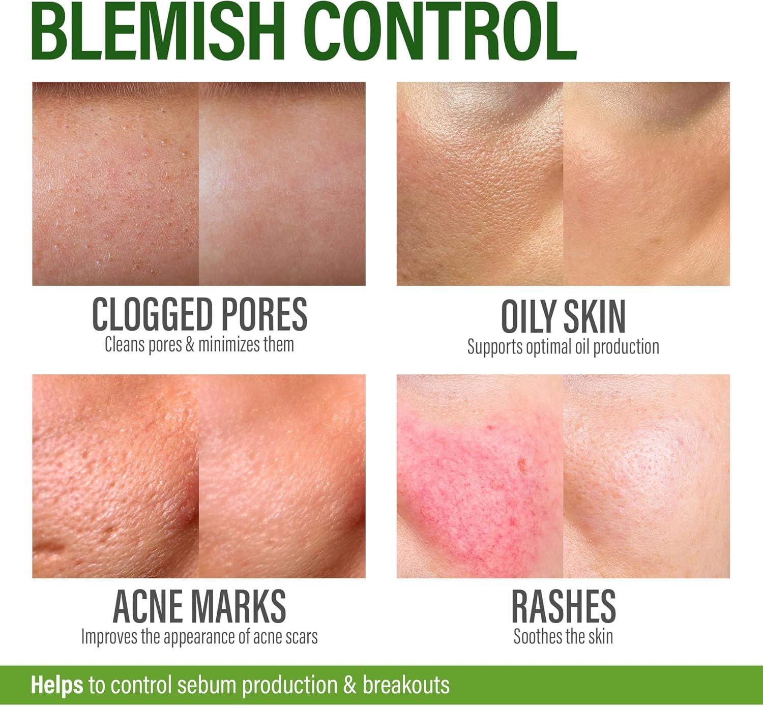 GRAMRIGHT-Acne Face Cream - Acne Spot Treatment for Face & Acne Dots